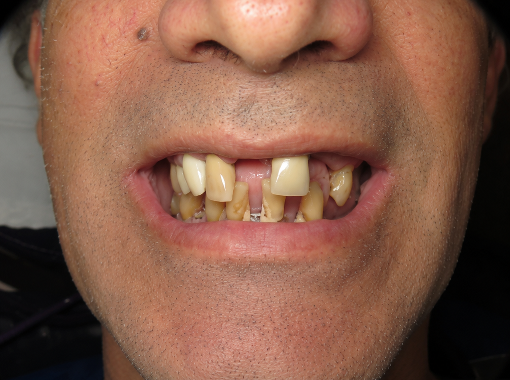 Boca antes de la colocación de implante dental (imagen ilustrativa)